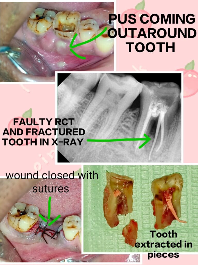 failed root canal traeatment in lower molar showing pus discharge supported by x-rays. extraction of the same tooth in 3 pieces and the wound closed by sutures.